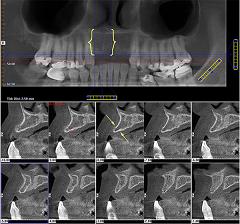 i-cat-scan-dental-implants.jpg, 14kB